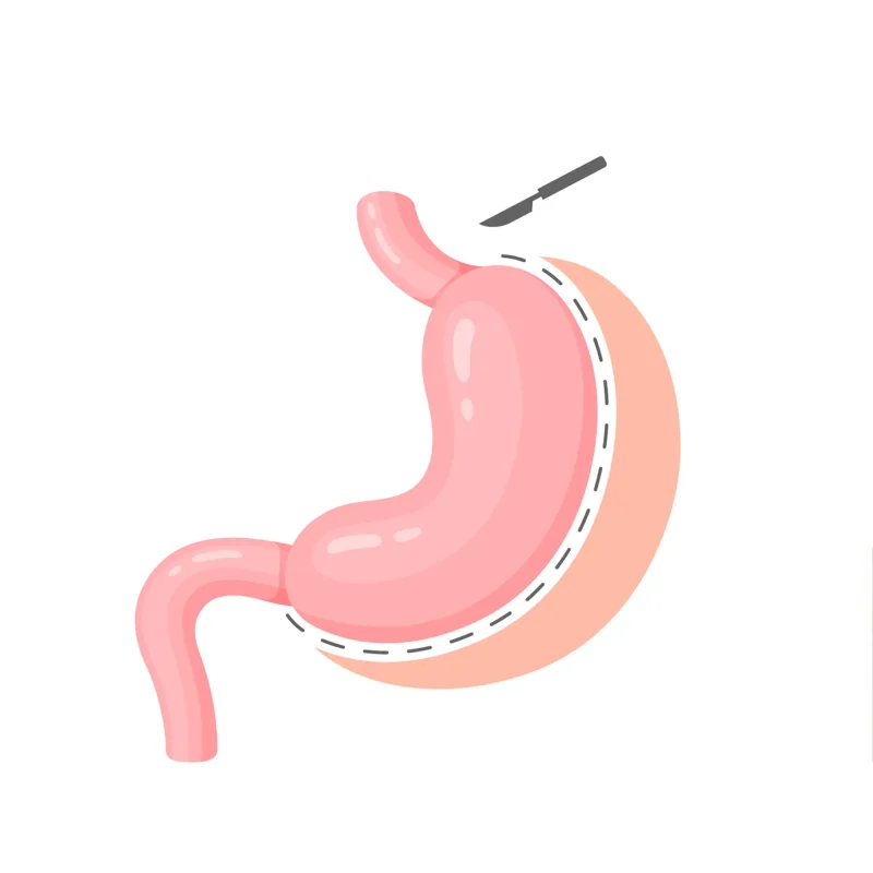 LUCCHESE-Sleeve-gastrectomy